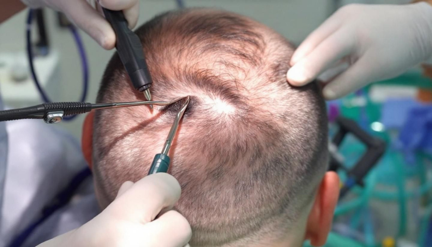 Comparaison des techniques de greffe capillaire : DHI contre FUE